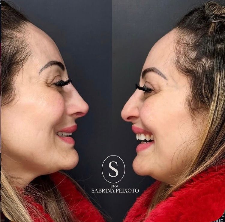 Antes e Depois